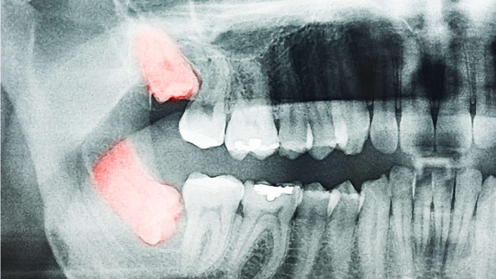 content-1509123547-untitled-design-teeth