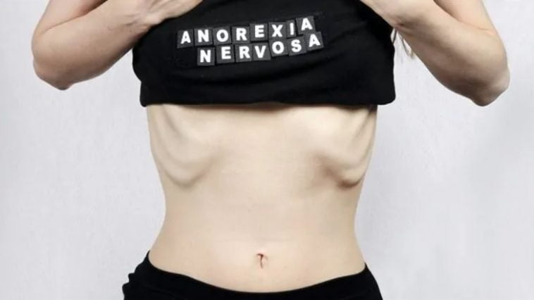 Anoreksiya Nervoza