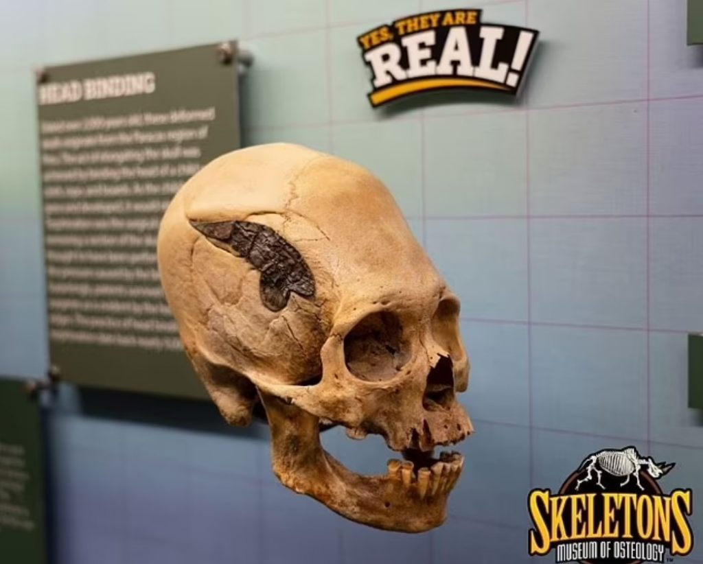 Resimdeki 2000 yıllık kafatasının, savaşta yaralanan ve kırığı onarmak için bir metal parçası yerleştirmek için ameliyat olan bir adama ait olduğuna inanılıyor.