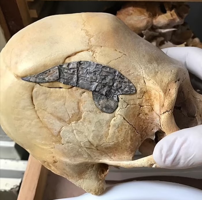 2000 yıl önce Perulu savaşçının kafasına yerleştirilen metal plaka dünyanın ilk kafatası ameliyatı olduğu düşünülüyor.