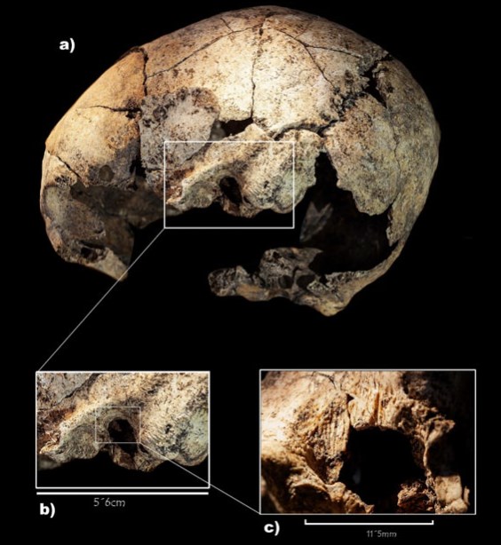 İspanya'da 5300 Yıl Öncesine ait Kulak Ameliyatının Kanıtları Bulundu
