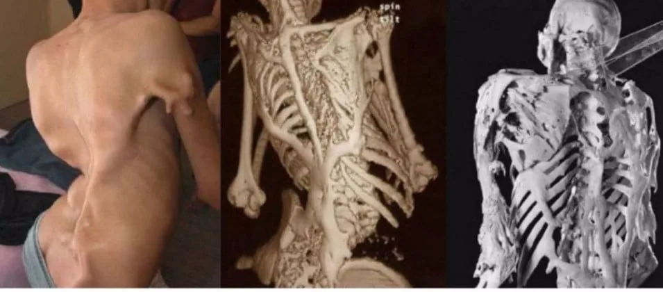 Araştırmacılar Kası Kemiğe Dönüştüren Nadir bir Hastalığı Araştırıyor