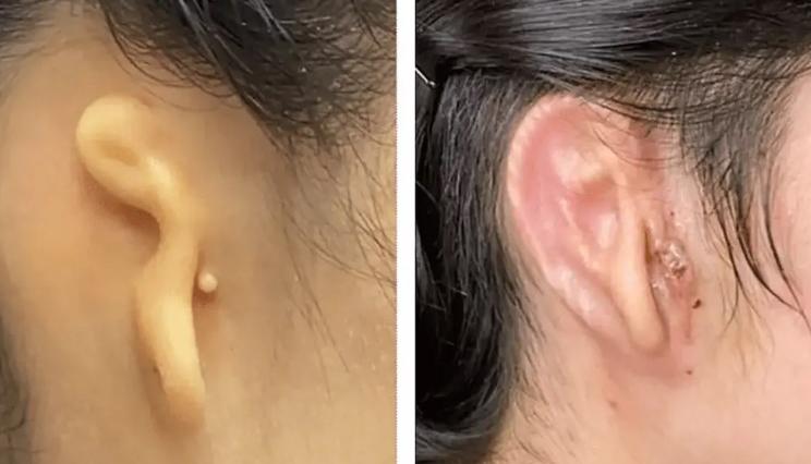 Doktorlar, İlk Başarılı 3D Baskılı Kulak Naklini Gerçekleştirdi!