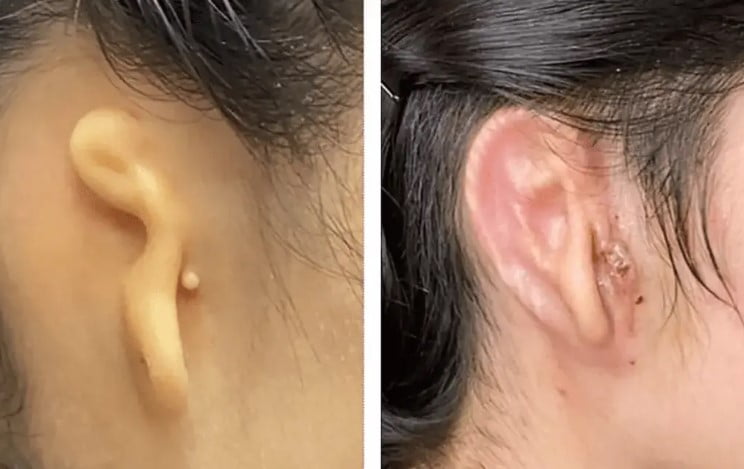 Doktorlar, İlk Başarılı 3D Baskılı Kulak Naklini Gerçekleştirdi!