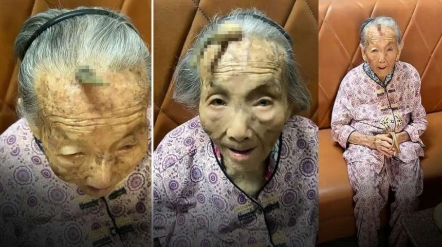 107 Yaşındaki Kadının kafasında 10 cm'lik Boynuzu Şaşkınlık Yarattı