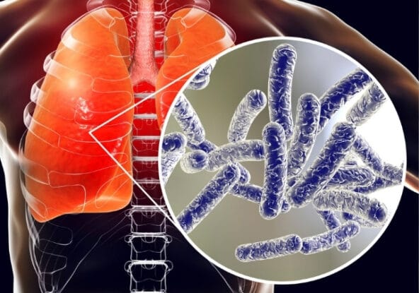 Legionella pneumophila, su damlacıkları yoluyla solunduğunda enfeksiyona neden olabilir.