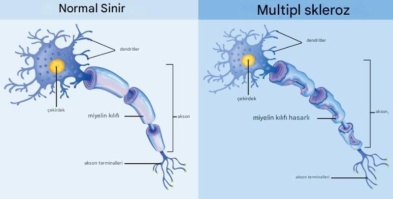 MS Hastalı Teşhisinden 15 Yıl Önce Ortaya Çıkan Erken Uyarı İşaretleri: Zihinsel Sağlık Sorunları Öncü Olabilir