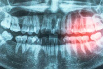 Ağız Sağlığı Kalp Sağlığının Anahtarı Olabilir: Diş Eti Hastalıkları ile Kalp-Damar Riski Arasındaki Bağ Güçleniyor