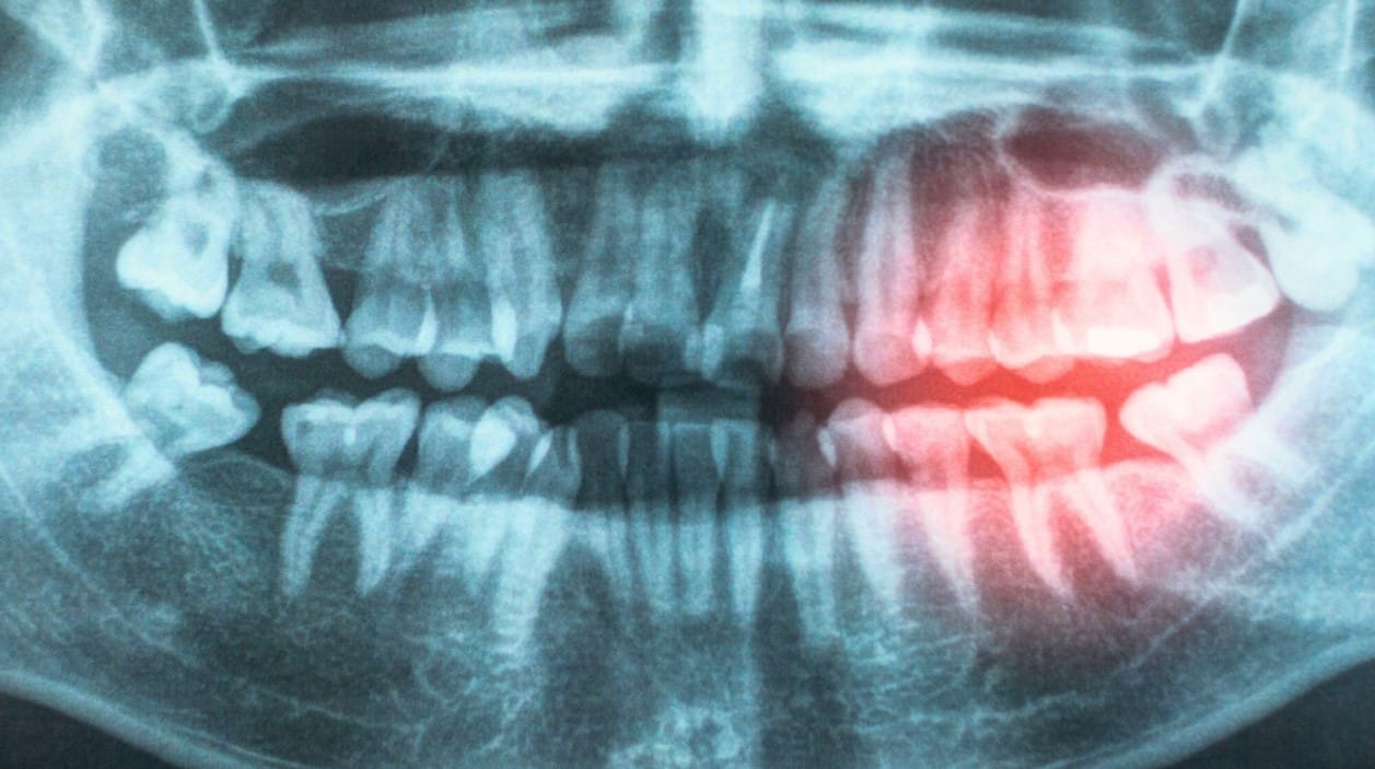 Ağız Sağlığı Kalp Sağlığının Anahtarı Olabilir: Diş Eti Hastalıkları ile Kalp-Damar Riski Arasındaki Bağ Güçleniyor