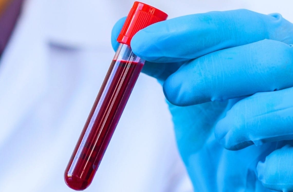 Basit Bir Kan Testi, Önümüzdeki 5–10 Yıl İçinde Ölüm Riskinizi Ortaya Koyabilir mi?