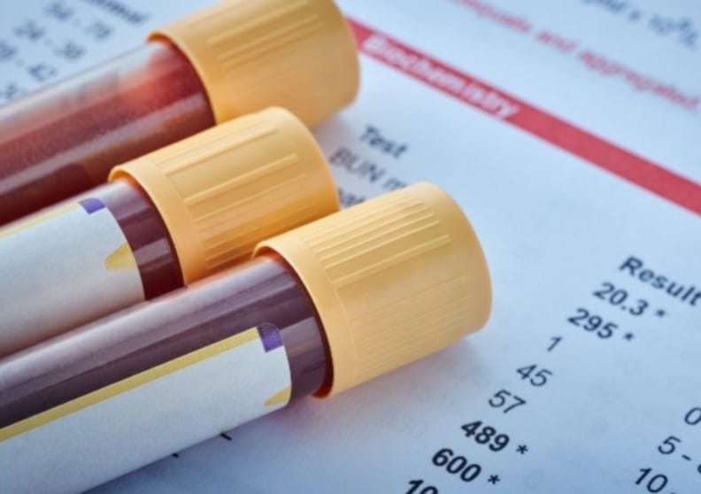 Basit Bir Kan Testi, Önümüzdeki 5–10 Yıl İçinde Ölüm Riskinizi Ortaya Koyabilir mi?