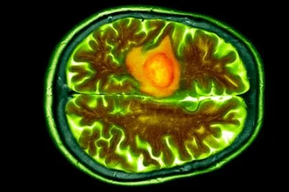 Burundan Damlatılan Nanodamlalar, En Ölümcül Beyin Kanserine Karşı Yeni Bir Savunma Hattı Olabilir