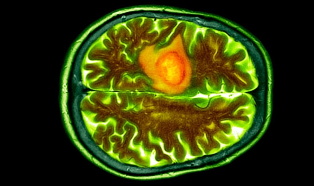 Burundan Damlatılan Nanodamlalar, En Ölümcül Beyin Kanserine Karşı Yeni Bir Savunma Hattı Olabilir