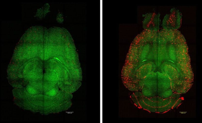 Eski Bir İlacın Alzheimer Bulgularını Geri Çevirdiği Keşfi Bilim Dünyasını Heyecanlandırdı