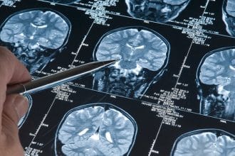 Eski Bir İlacın Alzheimer Bulgularını Geri Çevirdiği Keşfi Bilim Dünyasını Heyecanlandırdı