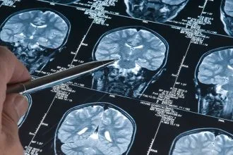 Eski Bir İlacın Alzheimer Bulgularını Geri Çevirdiği Keşfi Bilim Dünyasını Heyecanlandırdı